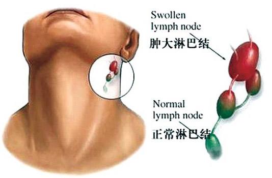因甲醛超標(biāo)而引起的淋巴癌怎么辦？