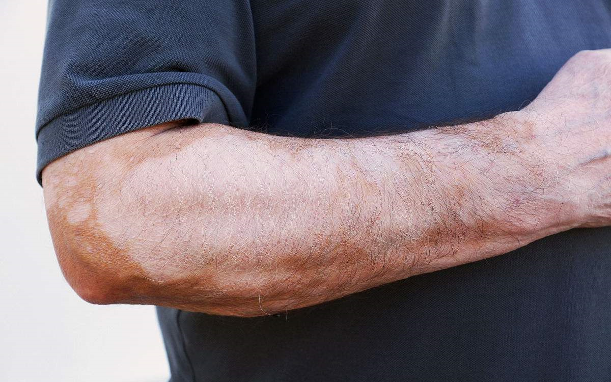 甲醛超標(biāo)和白癜風(fēng)有關(guān)系嗎？裝修污染對(duì)人體影響極大！