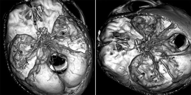 平時(shí)不注意甲醛超標(biāo)，50歲女子劇烈頭痛、惡心干嘔，一查已是癌癥晚期！