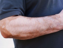 甲醛超標和白癜風有關系嗎？裝修污染對人體影響極大！